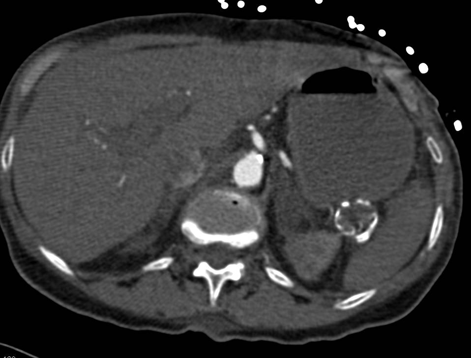 Splenic Artery Aneurysm and Left Upper Quadrant Bleed - CTisus CT Scan