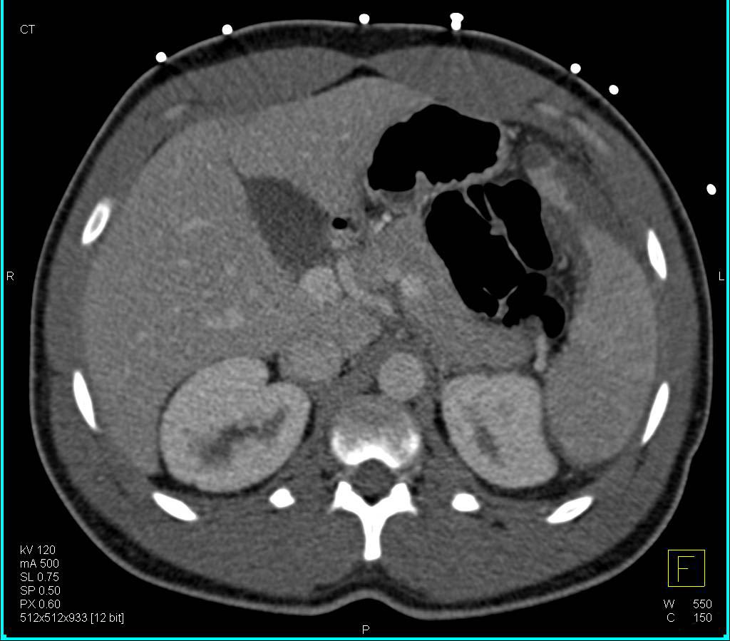 Splenic Infarction - CTisus CT Scan