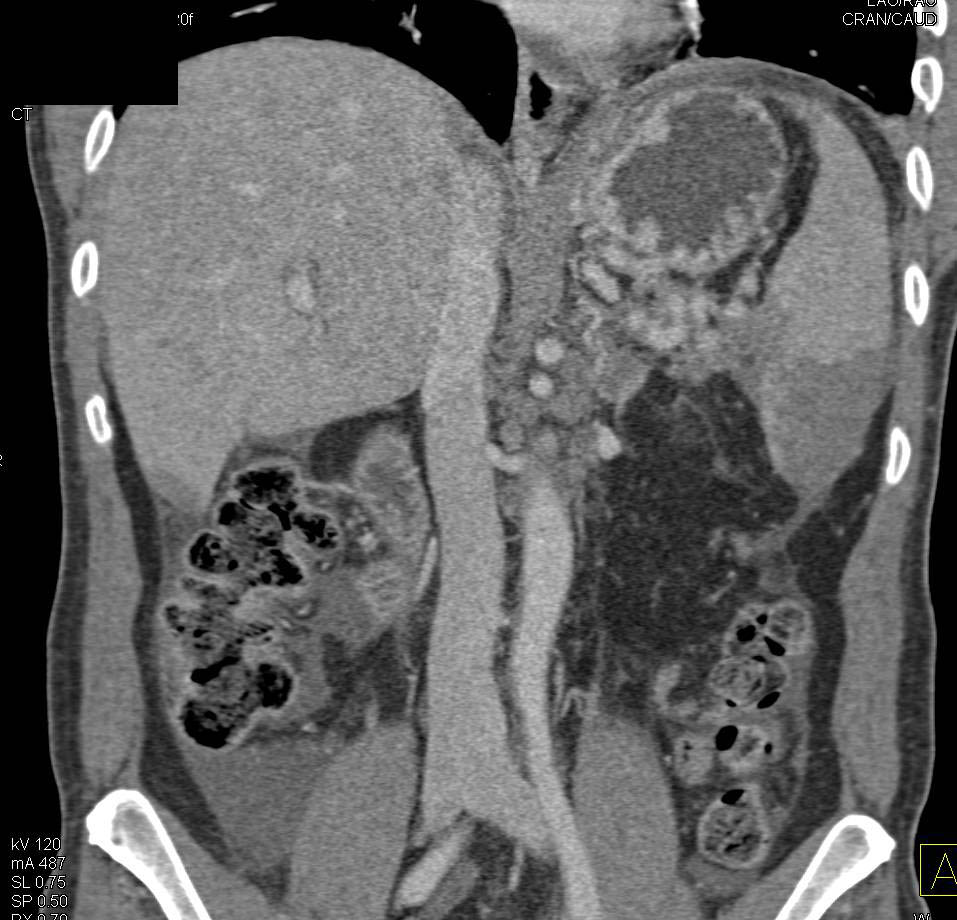 Splenic Infarction - CTisus CT Scan