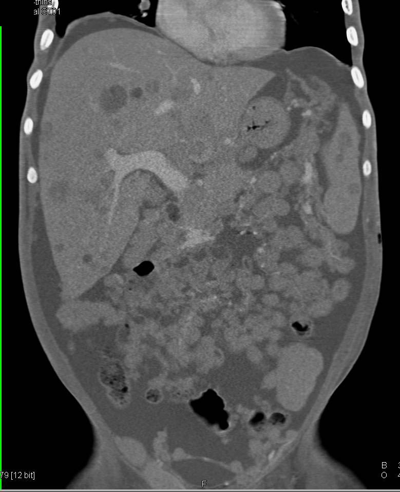 Metastatic Melanoma to Mesentery, Liver , Spleen and Perirenal Zones - CTisus CT Scan