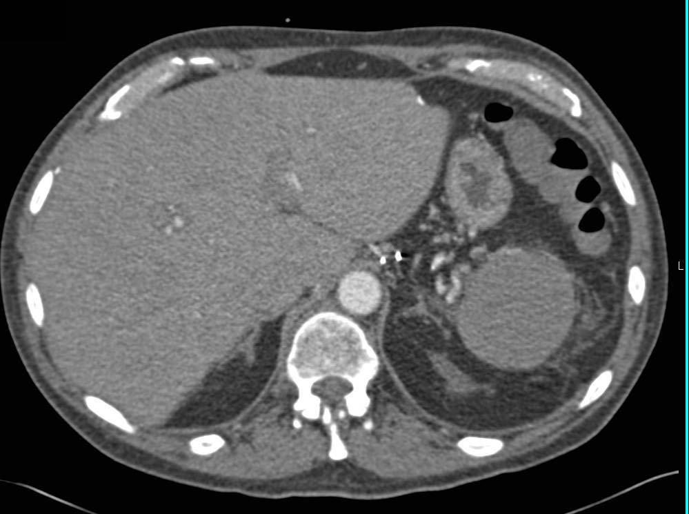 Splenosis - CTisus CT Scan