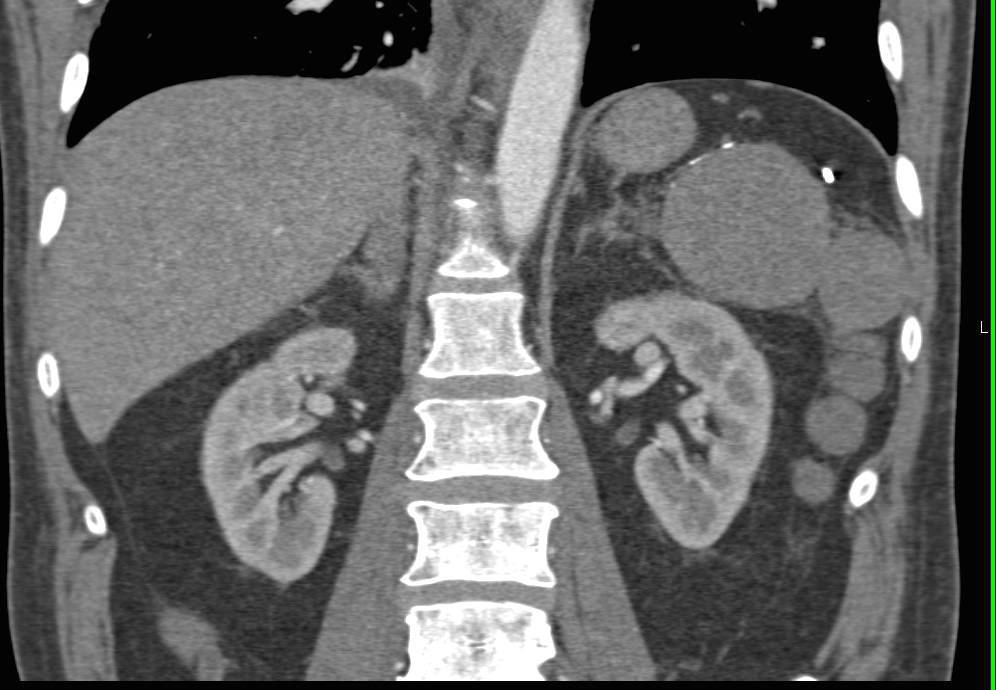 Beautiful Example of Splenosis - CTisus CT Scan