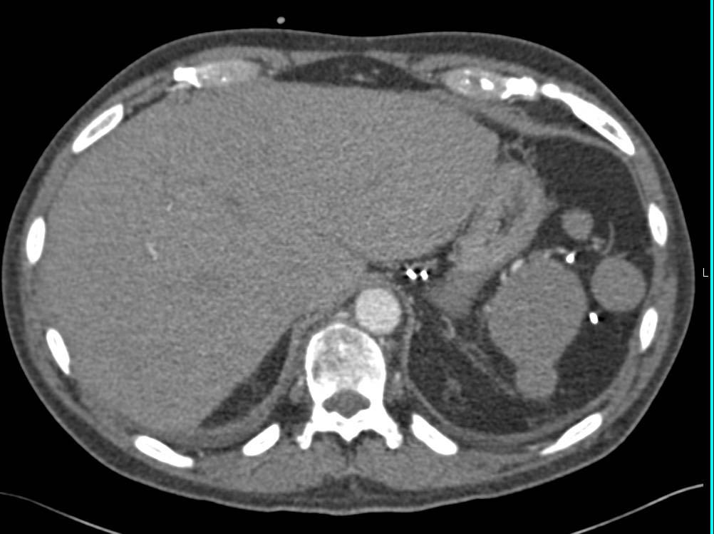 Multiple Splenules - CTisus CT Scan