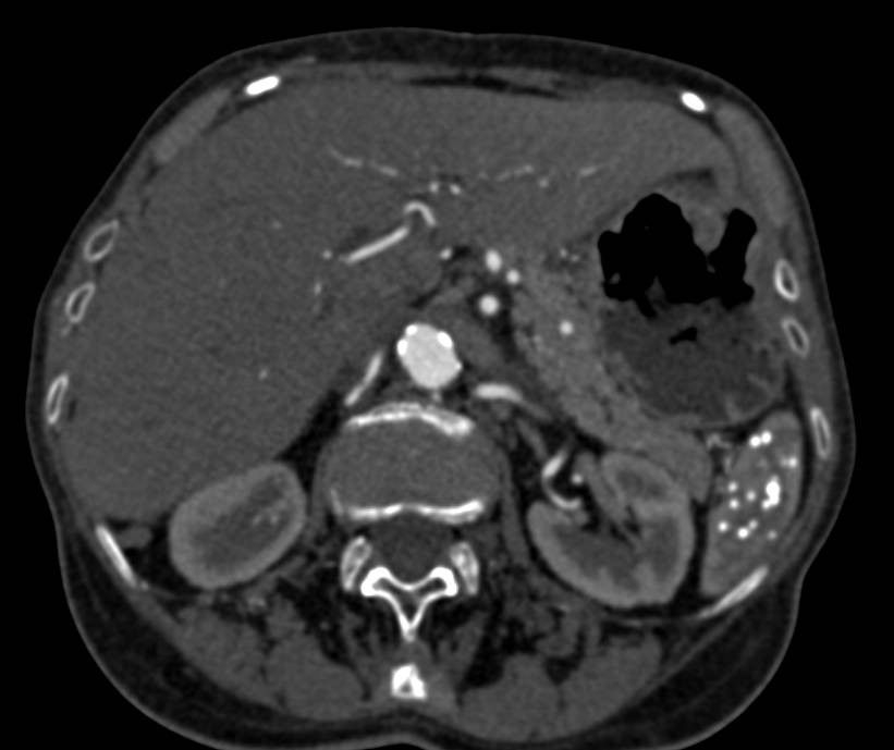 Splenic Granulomas - CTisus CT Scan