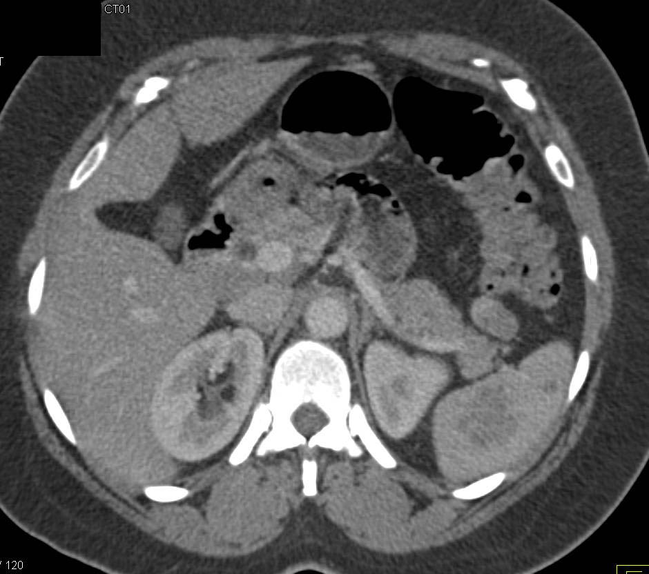 Splenic Lymphoma with Ascess - CTisus CT Scan