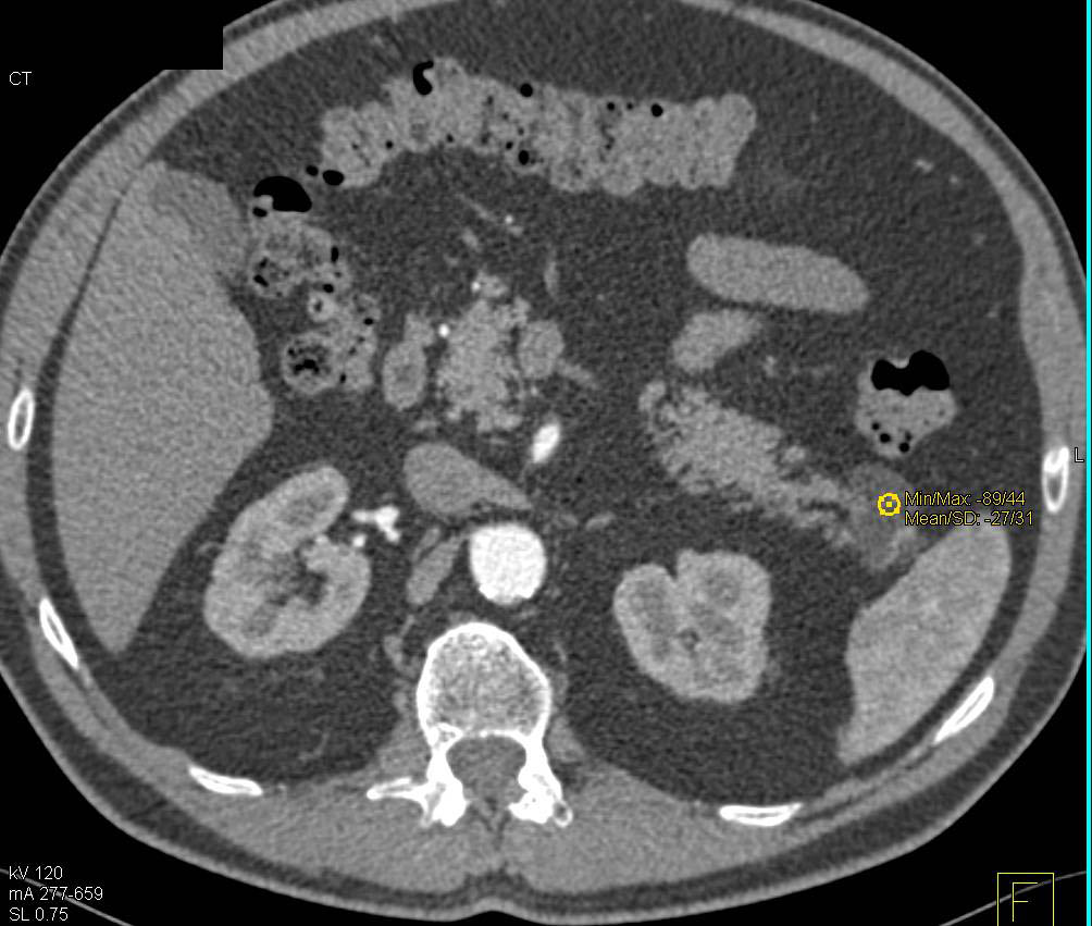 Splenic Hemangiomas and Lymphoepithelial Cyst of Pancreatic Tail - CTisus CT Scan