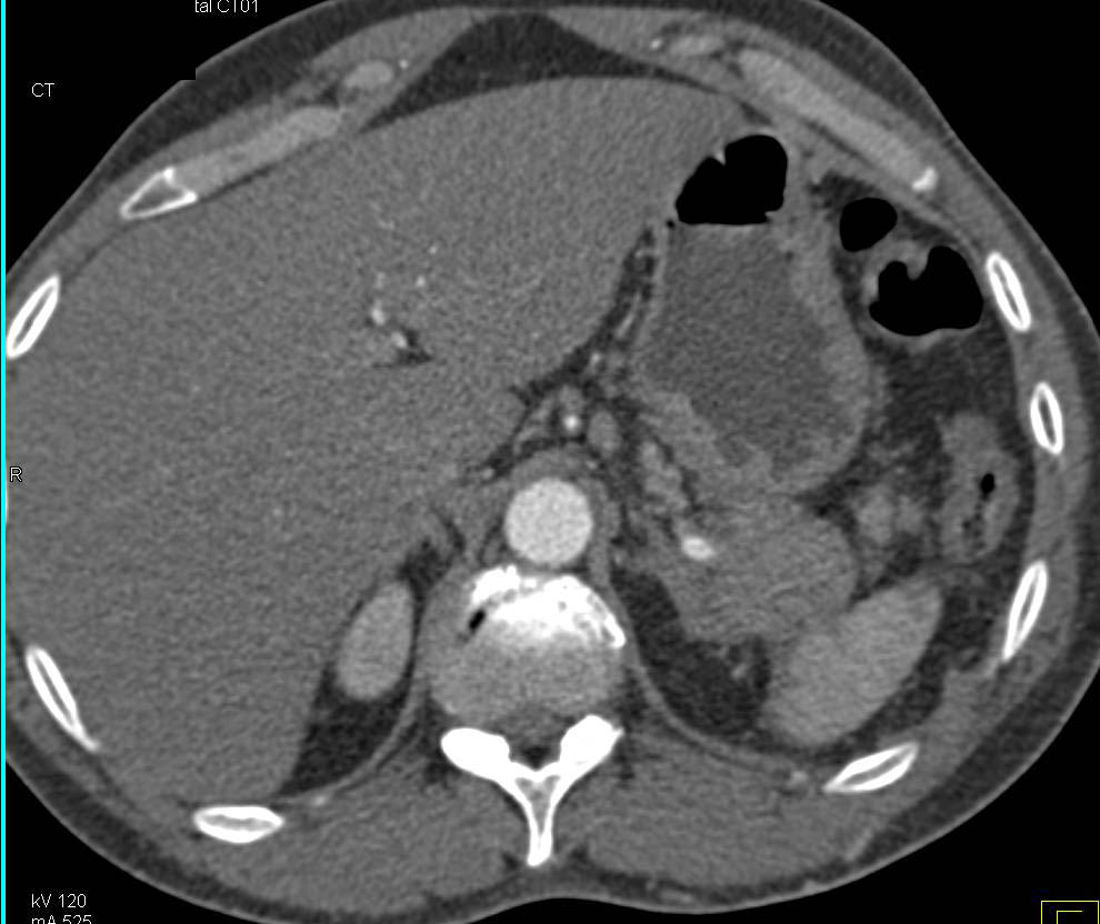 Splenic Artery Pseudoaneurysm Less Than 1cm in Size Due to Pancreatitis - CTisus CT Scan