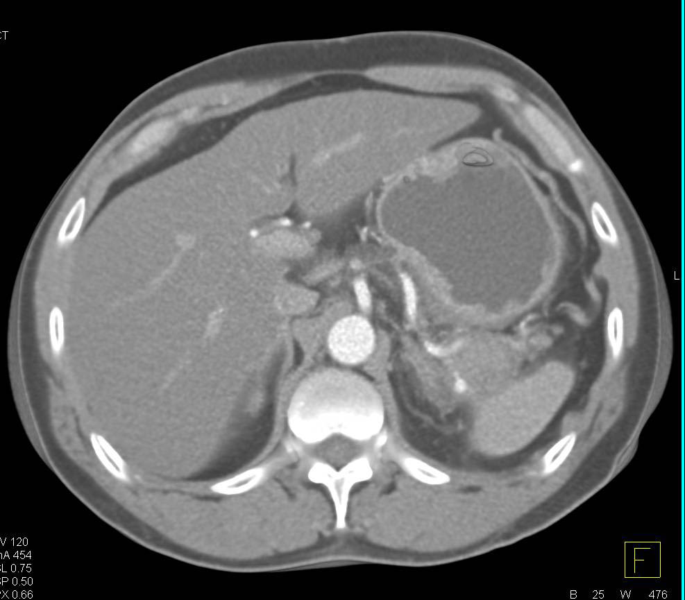 Splenic Artery Pseudoaneurysm Less Than 1cm in Size - CTisus CT Scan