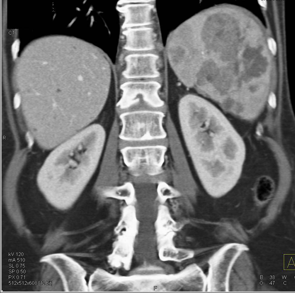 Adenocarcinoma of the Pancreas Metastatic to the Spleen - CTisus CT Scan
