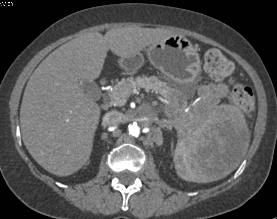 Splenic Lymphoma with Pancreatic Lesions as Well - CTisus CT Scan