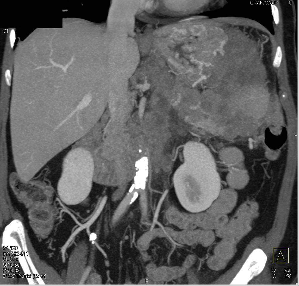 Splenic Lymphoma with Adenopathy - CTisus CT Scan