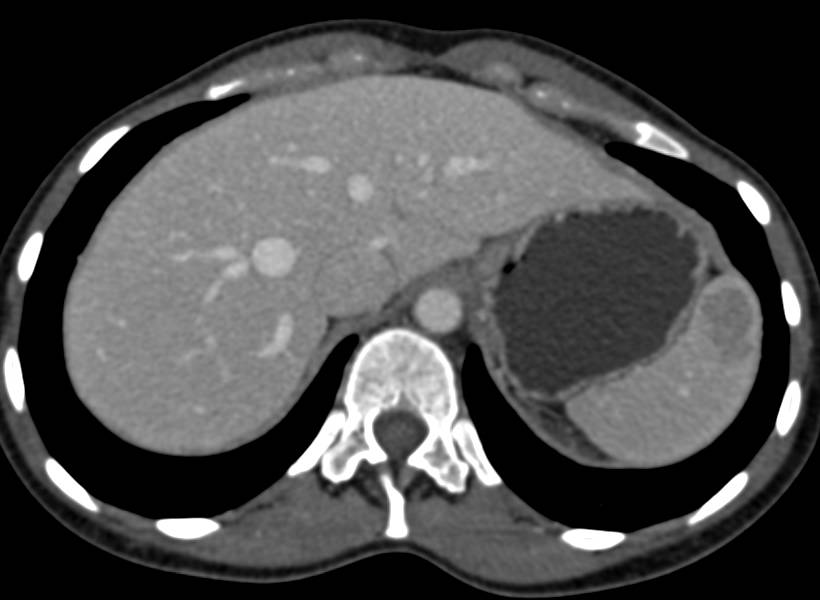 Splenic Hamartoma - CTisus CT Scan