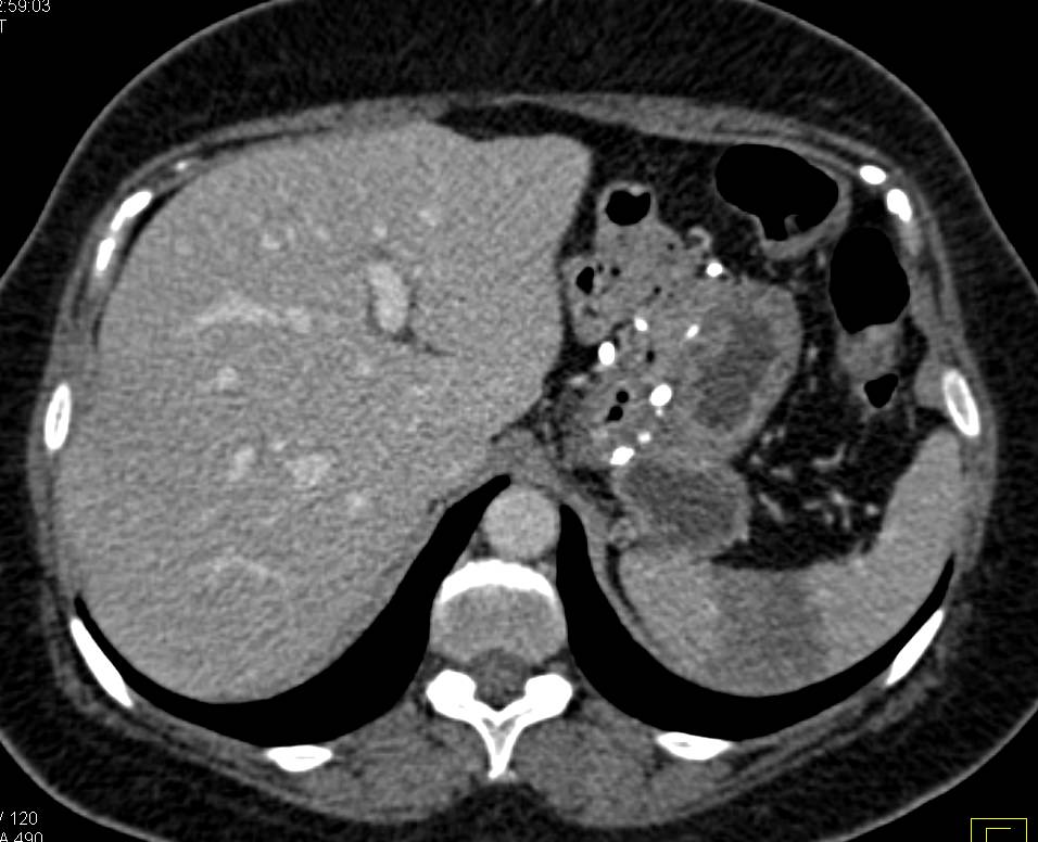 Splenic Artery Aneurysm with Embolization (pre/post) - CTisus CT Scan