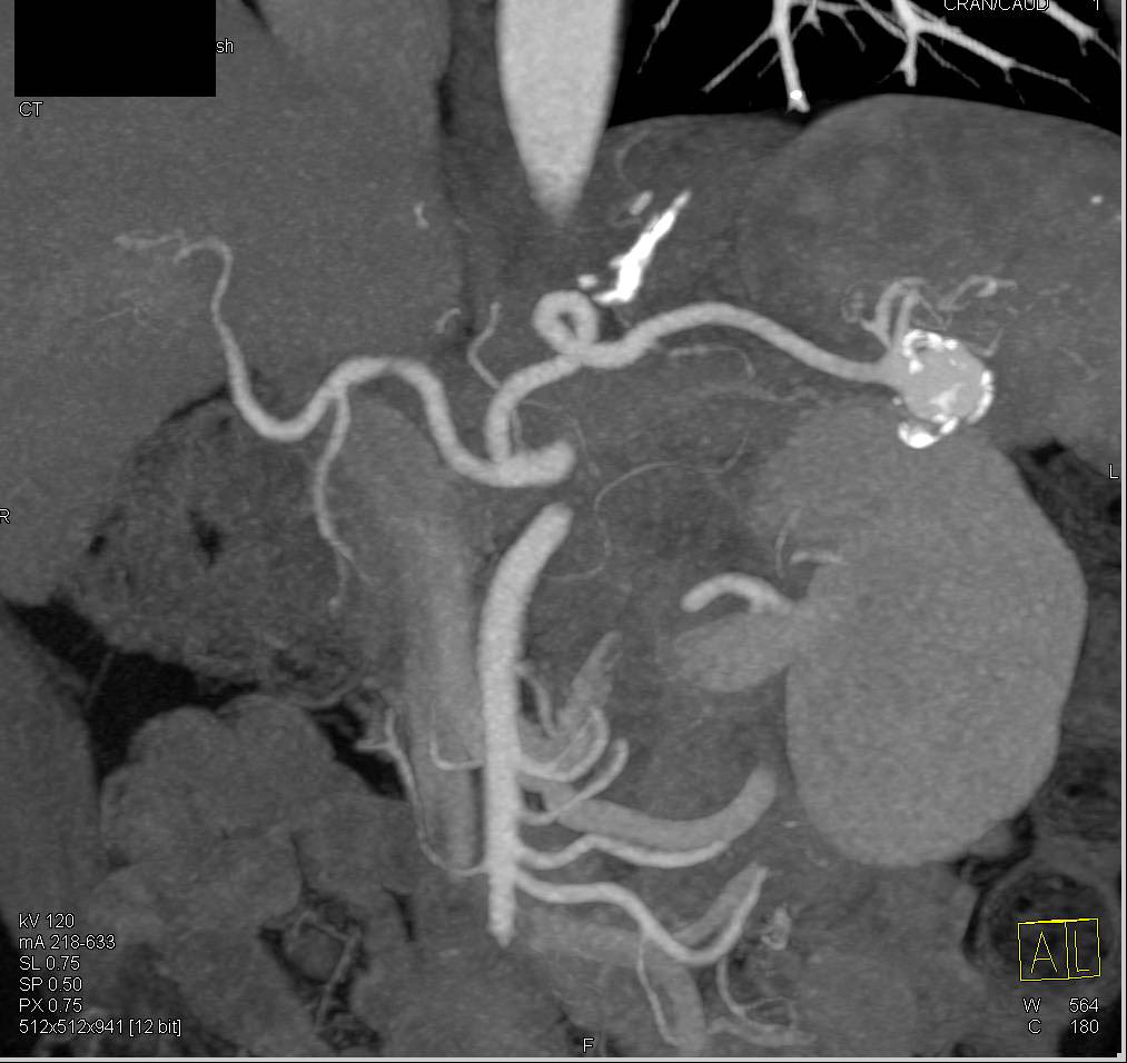 Splenic Artery Aneurysm - CTisus CT Scan