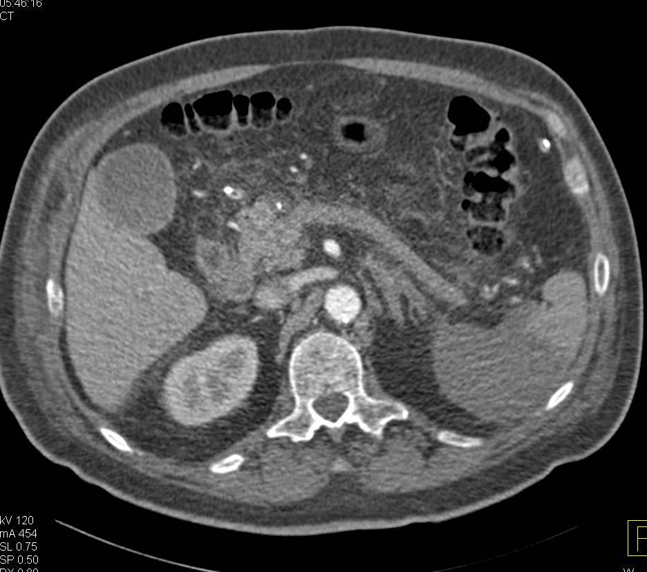 Splenic Infarction - CTisus CT Scan