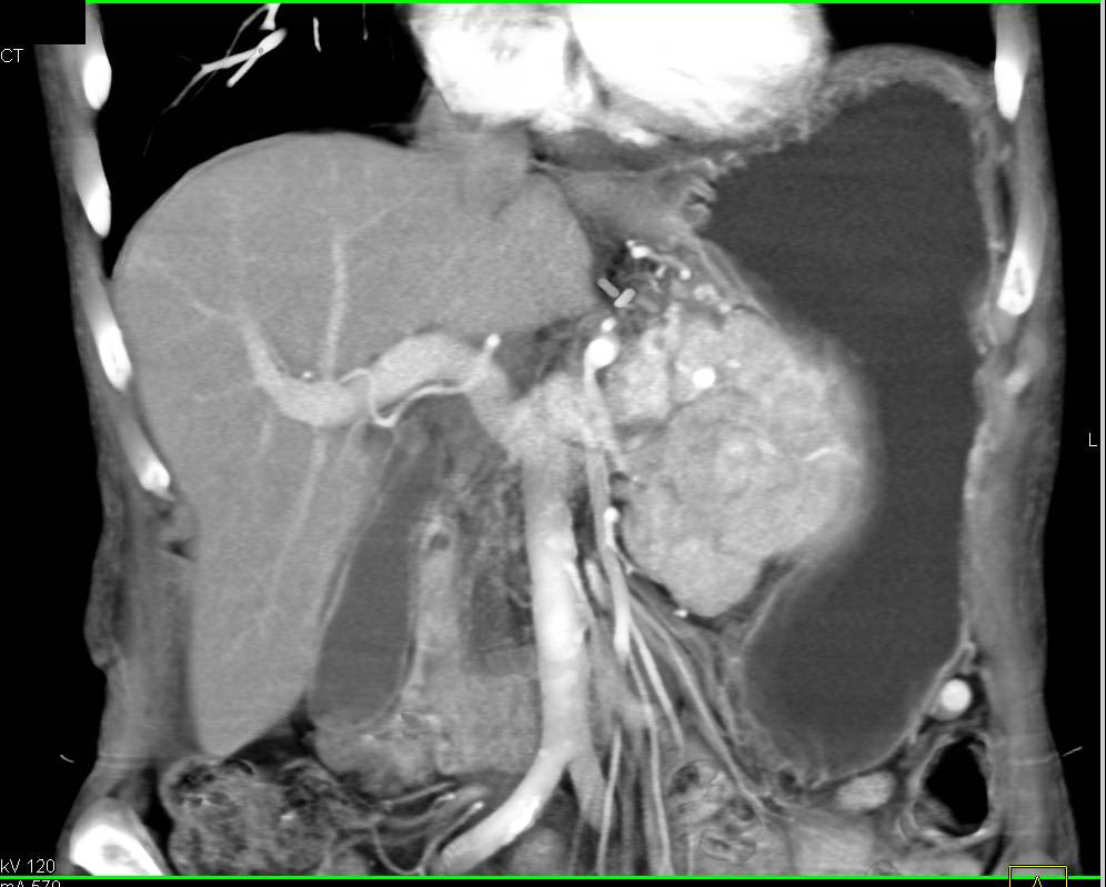 Splenic Vein Occlusion with Extensive Collaterals due to Neuroendocrine Tumor - CTisus CT Scan
