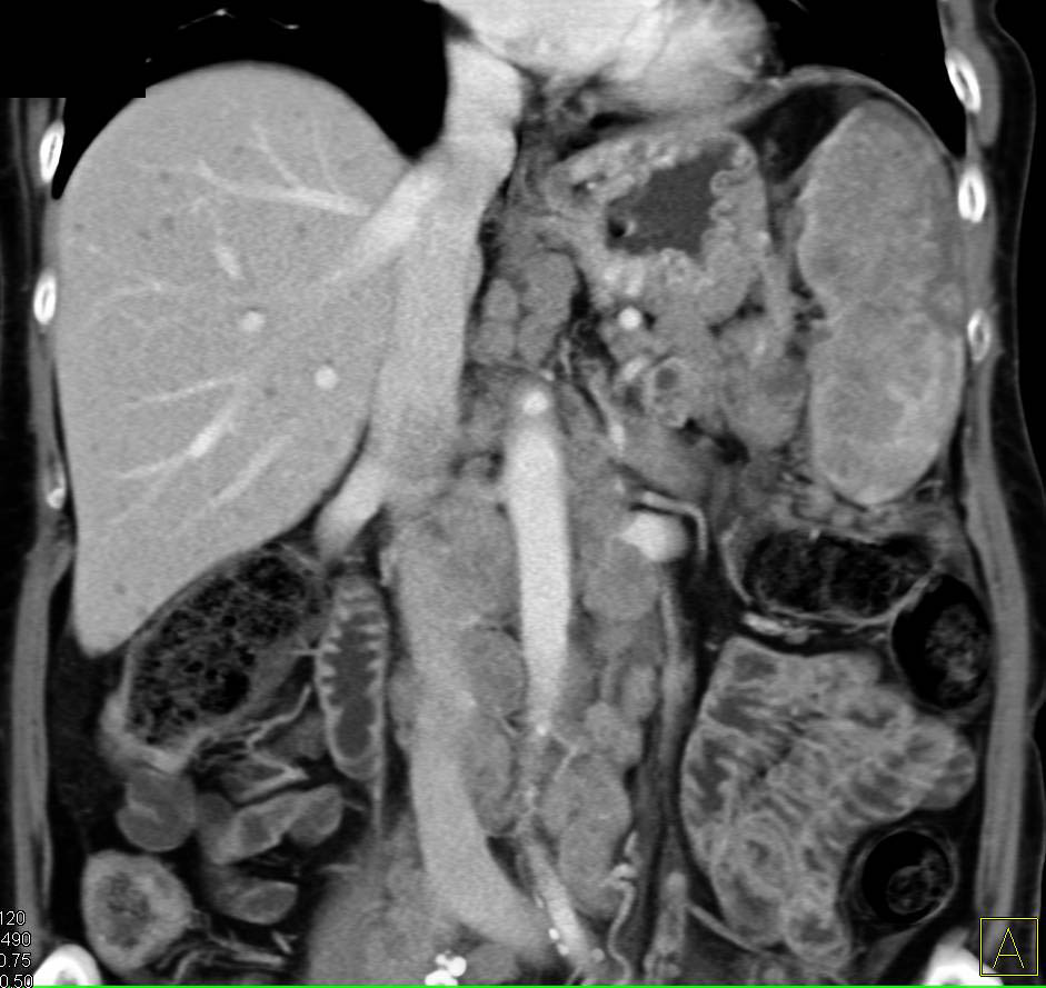 Lymphoma with Extensive Adenopathy and Splenic Infiltration - CTisus CT Scan