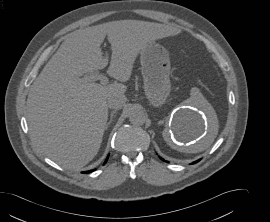 Calcified Splenic Cyst - CTisus CT Scan