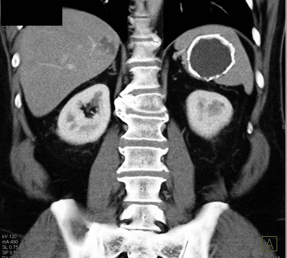 Calcified Splenic Cyst - CTisus CT Scan