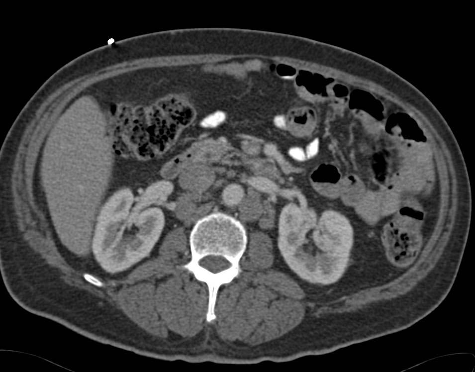 Lymphoma with Splenic Involvement and Bulky Paraaortic Adenopathy - CTisus CT Scan