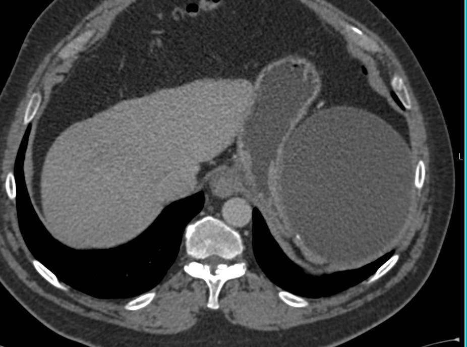 Splenic Cyst - CTisus CT Scan