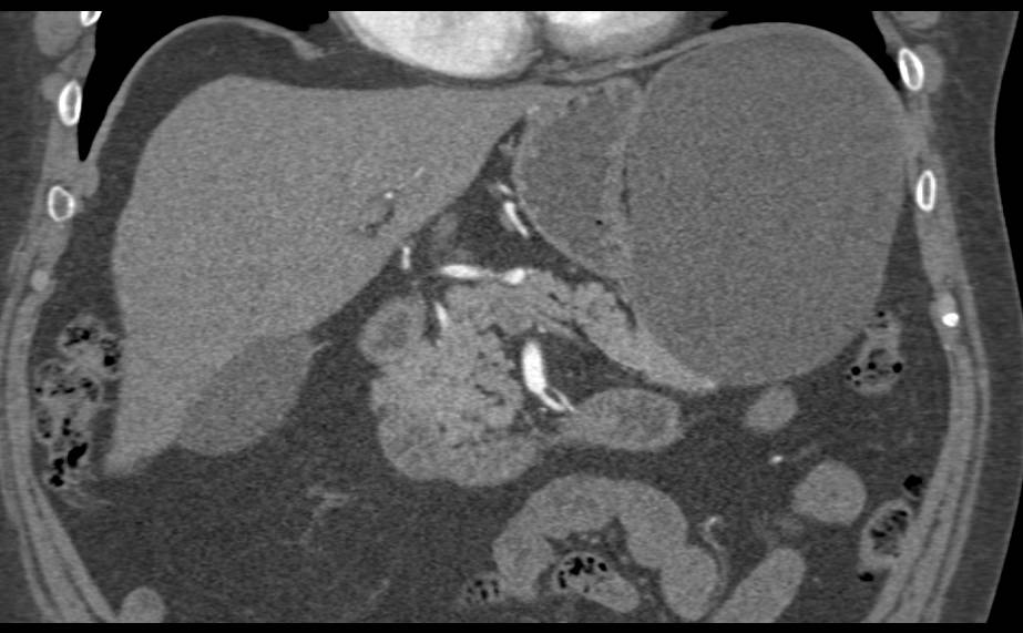 Splenic Cyst - CTisus CT Scan