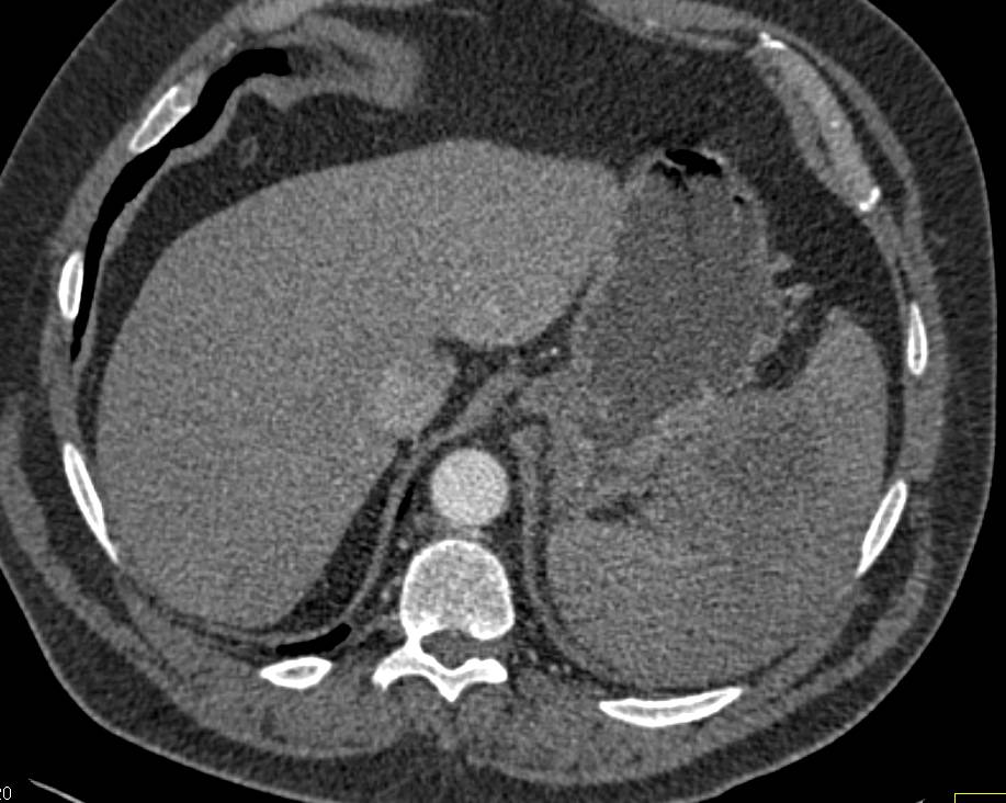 Carcinoma of the Tail of the Pancreas Invades the Spleen - CTisus CT Scan