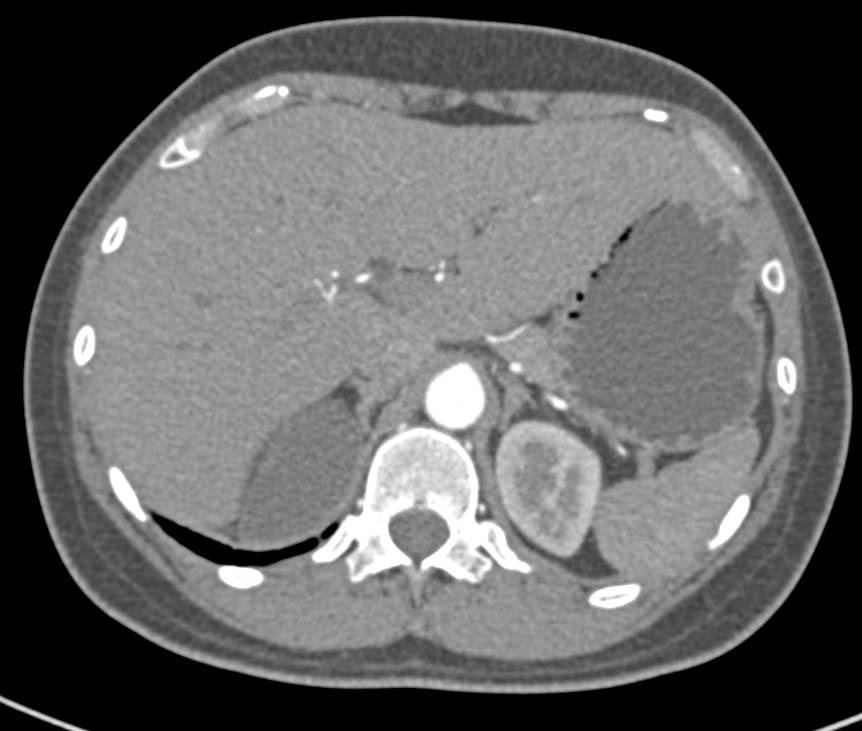 Adrenal Cyst on the right - CTisus CT Scan