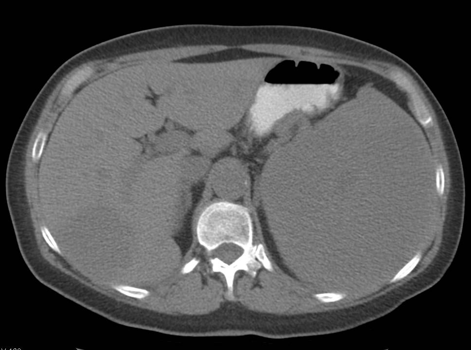 Splenic Lymphoma - CTisus CT Scan