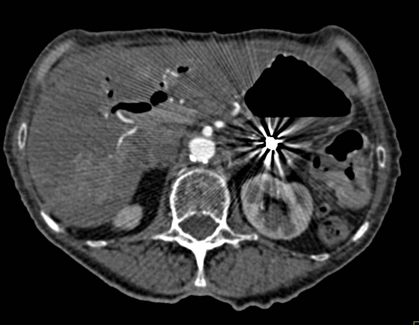 Coiling of Splenic Artery Aneurysm - CTisus CT Scan