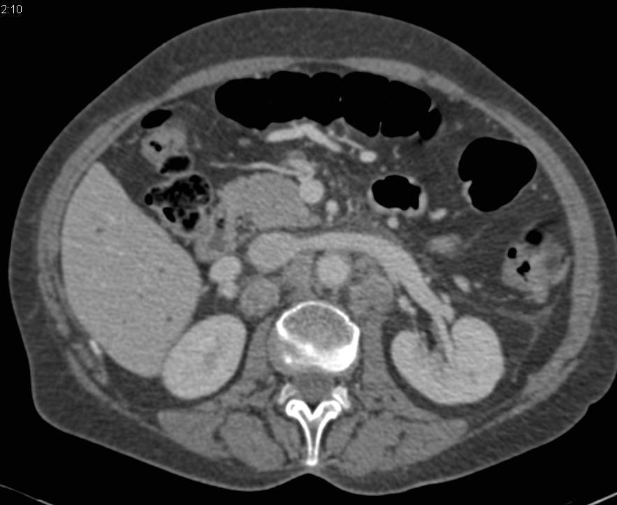 Lymphoma Involves the Spleen ,Liver and Para-aortic Adenopathy - CTisus CT Scan