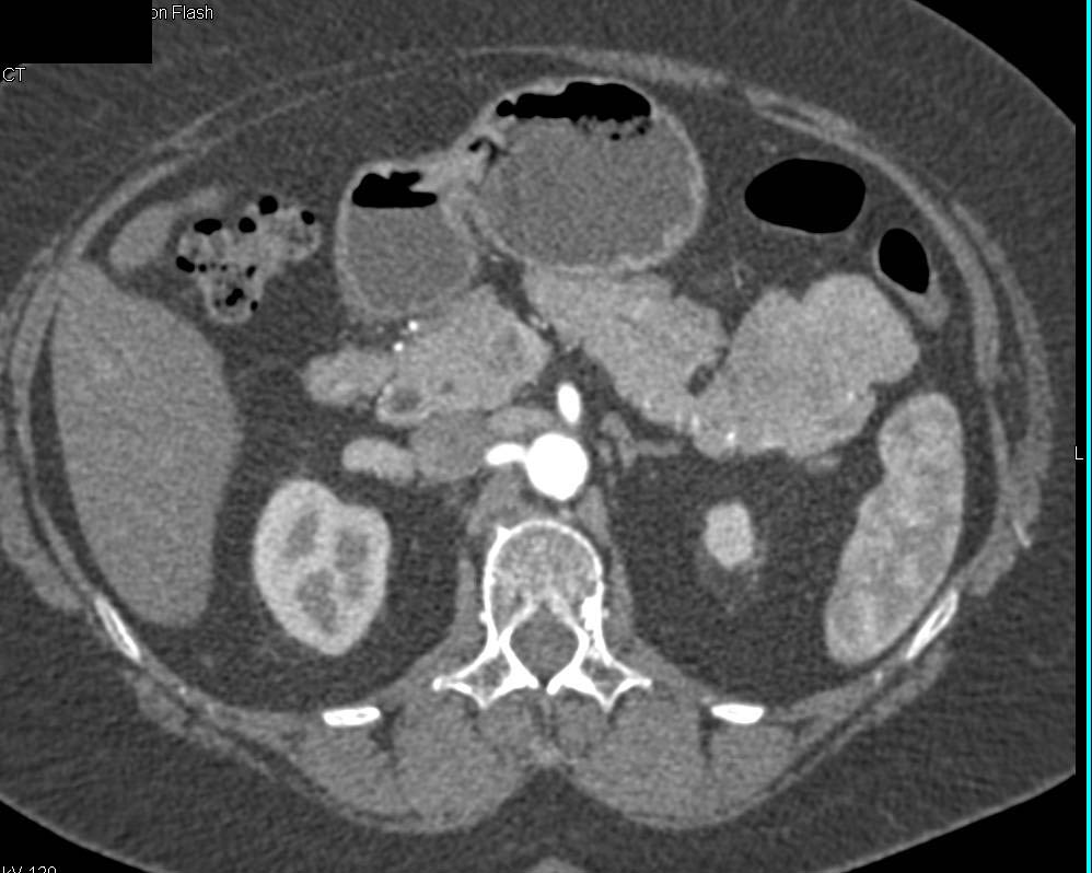 Large Accessory Spleen Simulates a Tail of the Pancreas Mass - CTisus CT Scan
