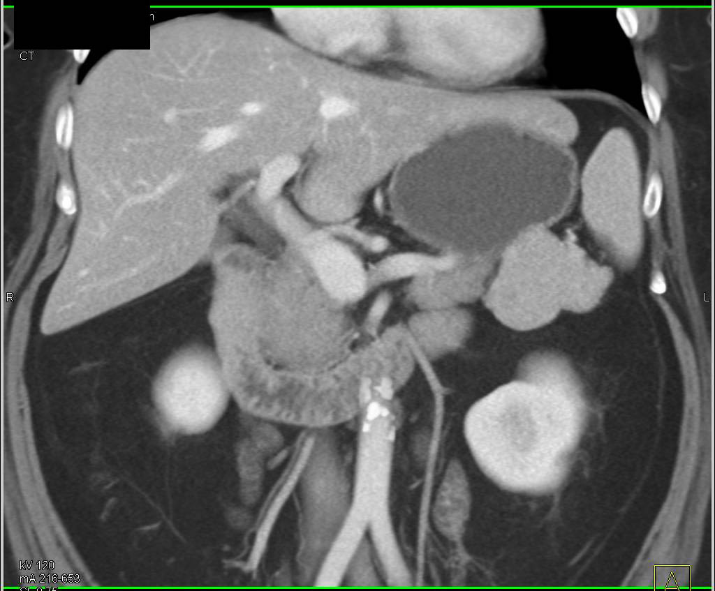 Large Accessory Spleen - CTisus CT Scan
