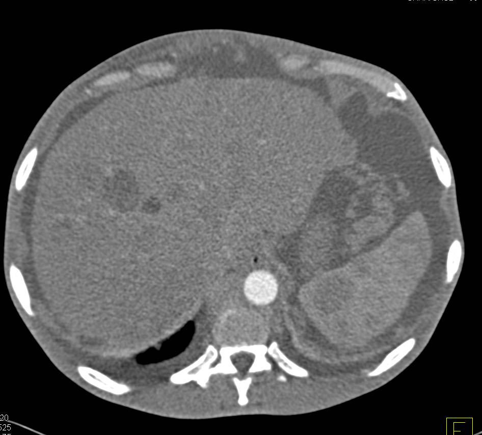 Metastatic Melanoma - CTisus CT Scan