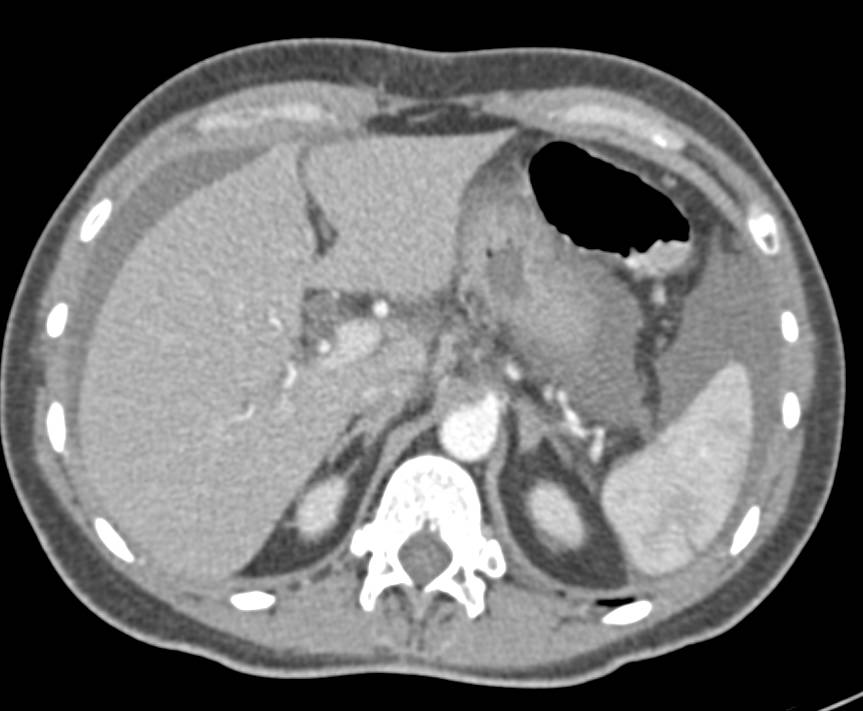 Splenic Laceration with Hemoperitoneum - CTisus CT Scan