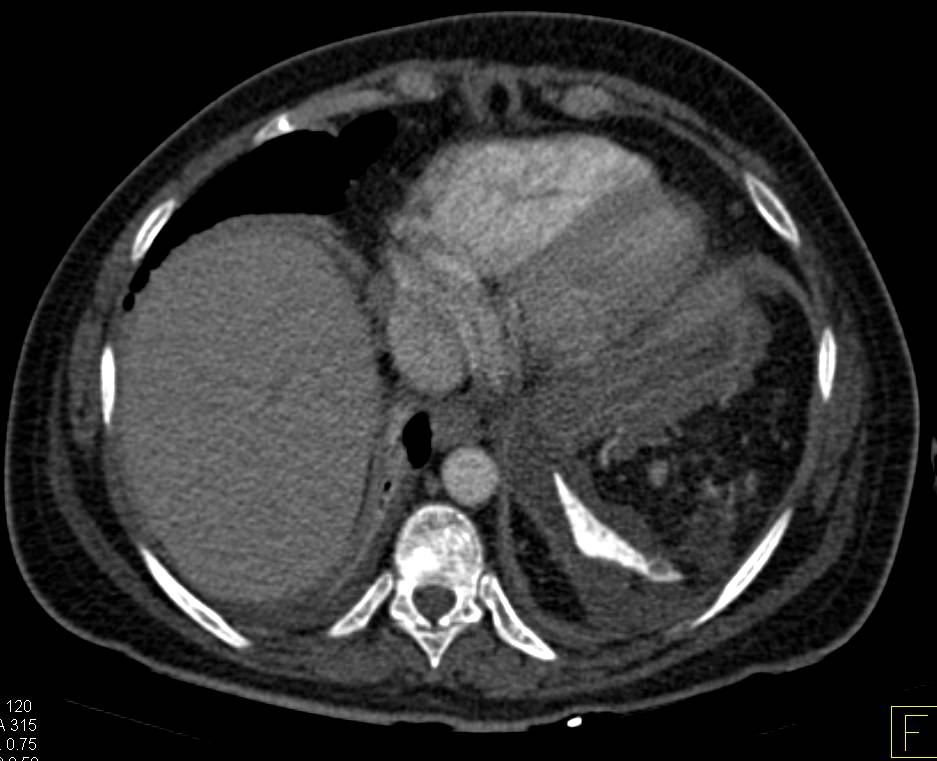 Pancreatitis in a Patient with Sickle Cell Disease - CTisus CT Scan