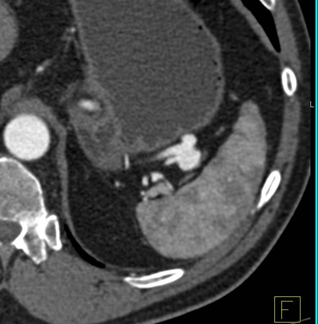 Splenic Artery Aneurysm in Multiple Perspectives - CTisus CT Scan