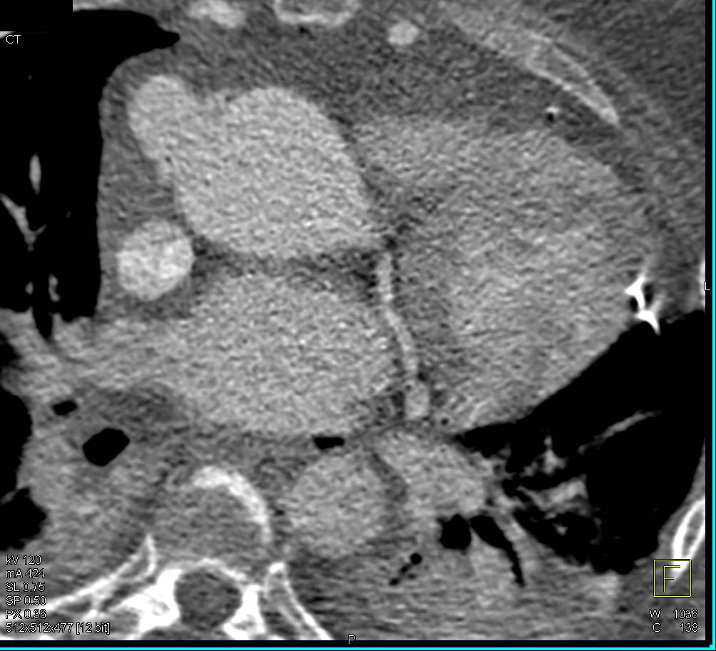 Splenic Infarct s/p Coarctation of the Aorta (COA) Repair - CTisus CT Scan