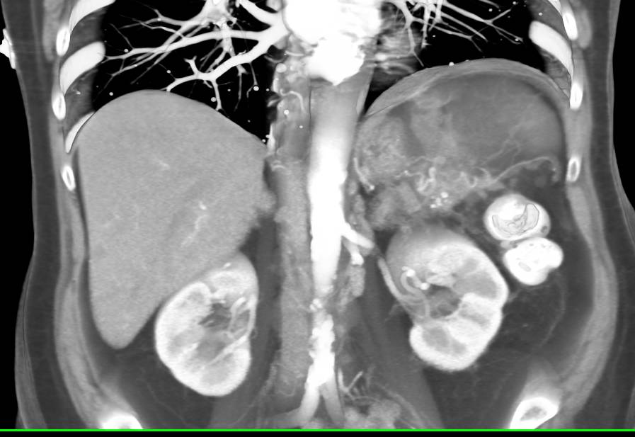 Chronic Pancreatitis and Splenic Infarcts - CTisus CT Scan