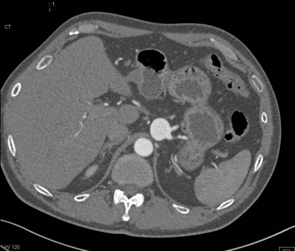 Splenic Artery Aneurysm - CTisus CT Scan