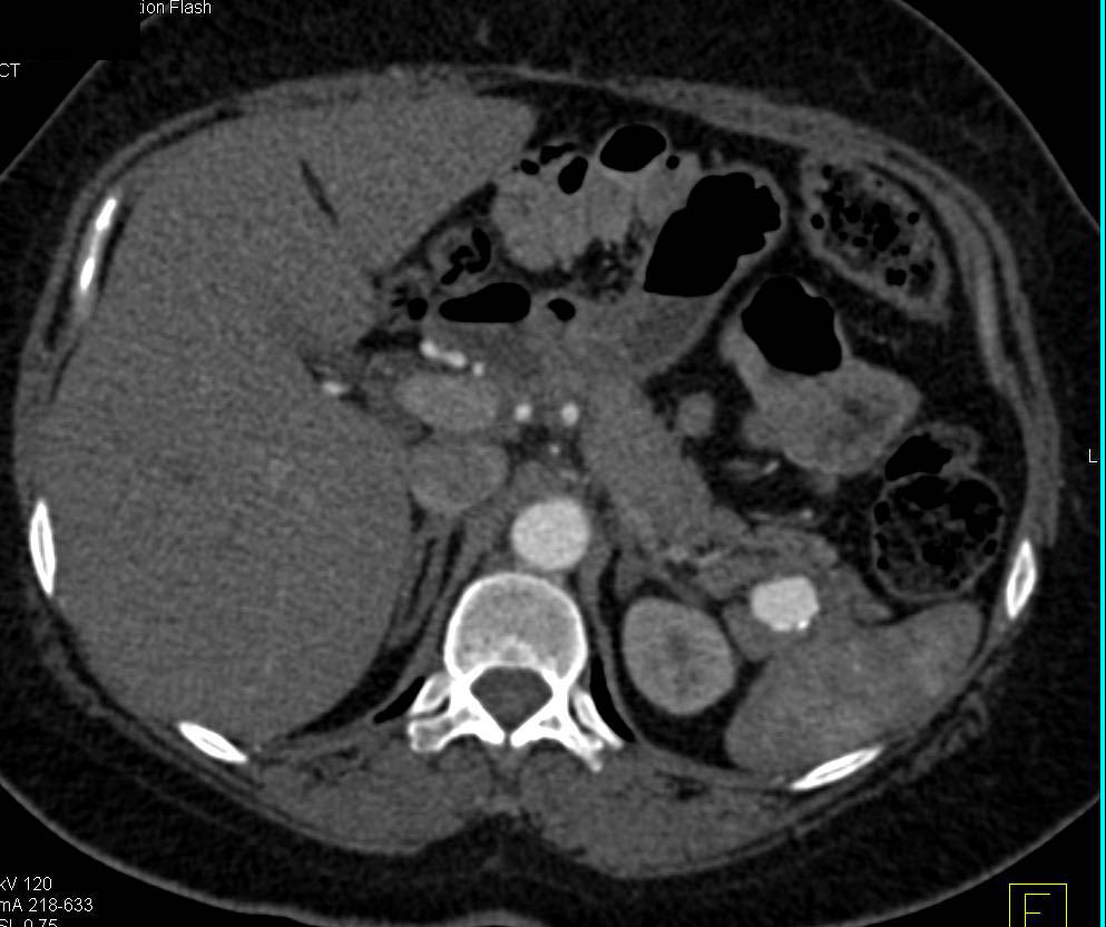 Splenic Artery Aneurysm - CTisus CT Scan