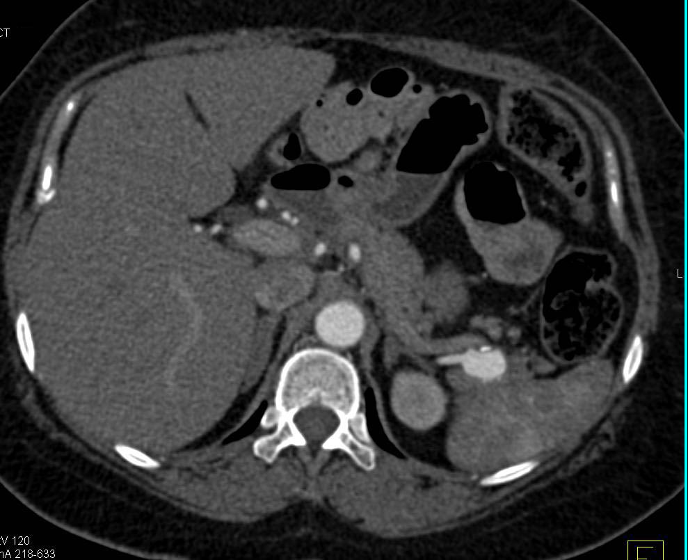 Splenic Artery Aneurysm - CTisus CT Scan