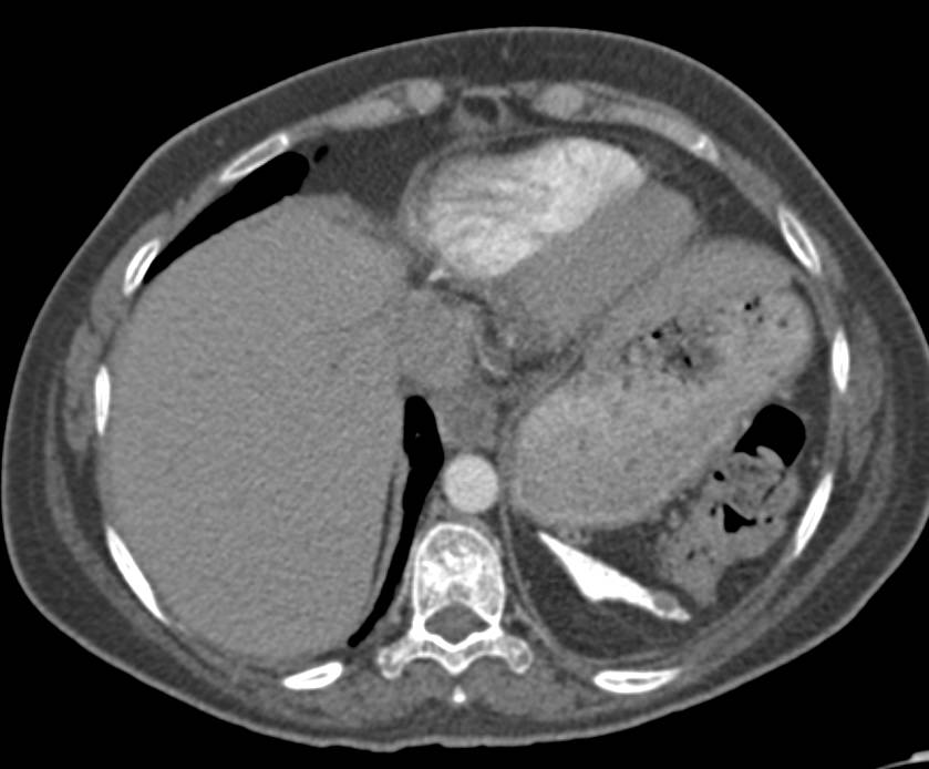 Calcified Atrophic Spleen in Sickle Cell Disease - CTisus CT Scan