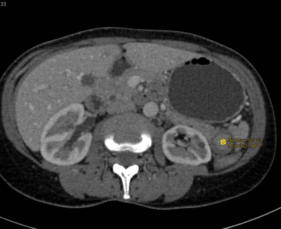 Accessory Spleen Simulates a Pancreatic Mass - Spleen Case Studies ...