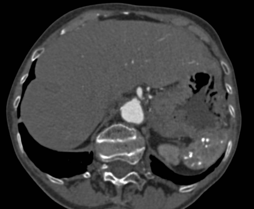 Granulomatous Disease in Spleen - Spleen Case Studies - CTisus CT Scanning