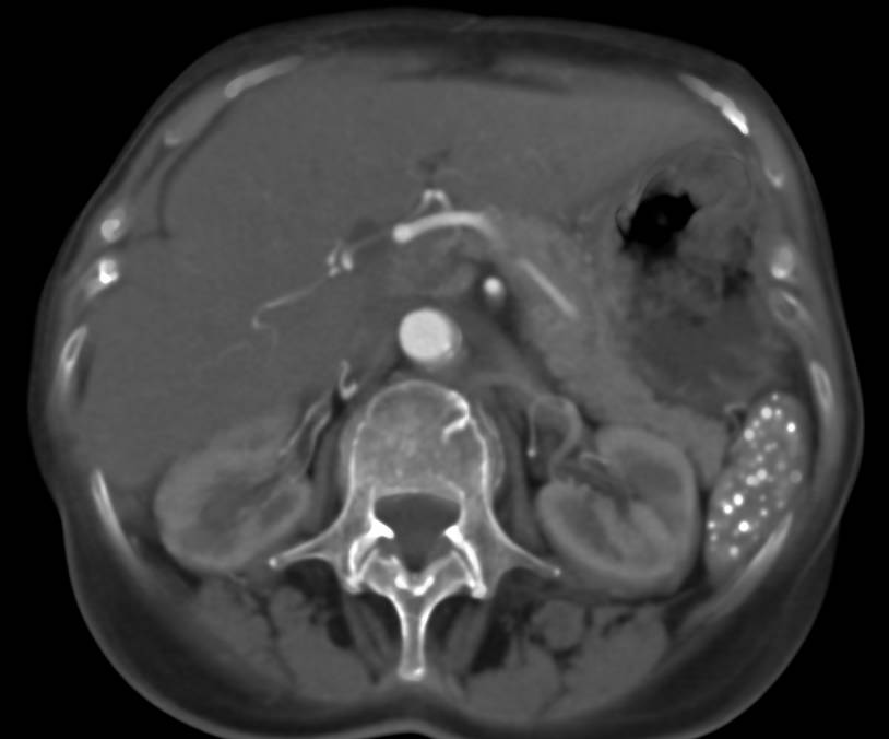 Granulomatous Disease in Spleen - Spleen Case Studies - CTisus CT Scanning