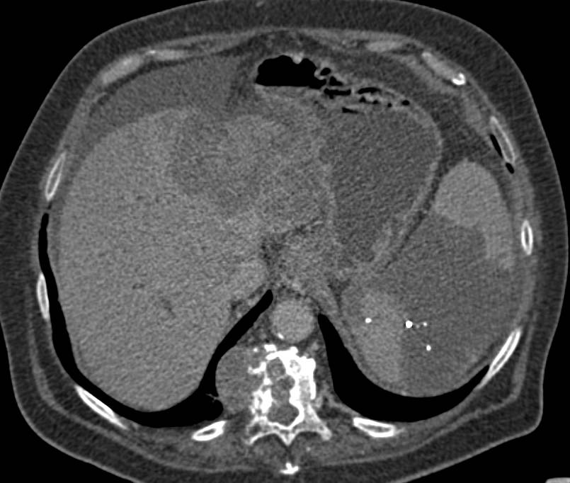 Splenic Infarct in Hepatocellular Carcinoma (Hepatoma) Patient with Bone Metastases - CTisus CT Scan