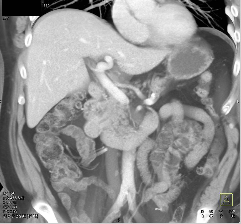 Splenic Granulomas - CTisus CT Scan