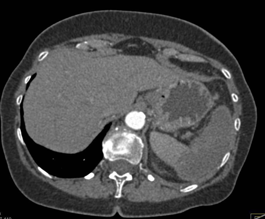 Global Splenic Infarction in Patient with Pancreatic Cancer - CTisus CT Scan