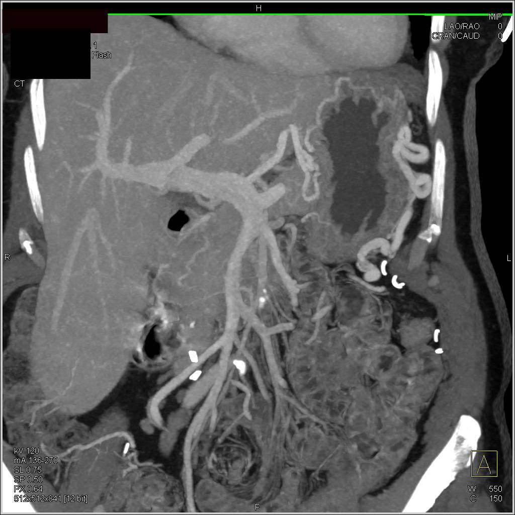 Splenic Infarct in Patient with Pancreatic Cancer - CTisus CT Scan